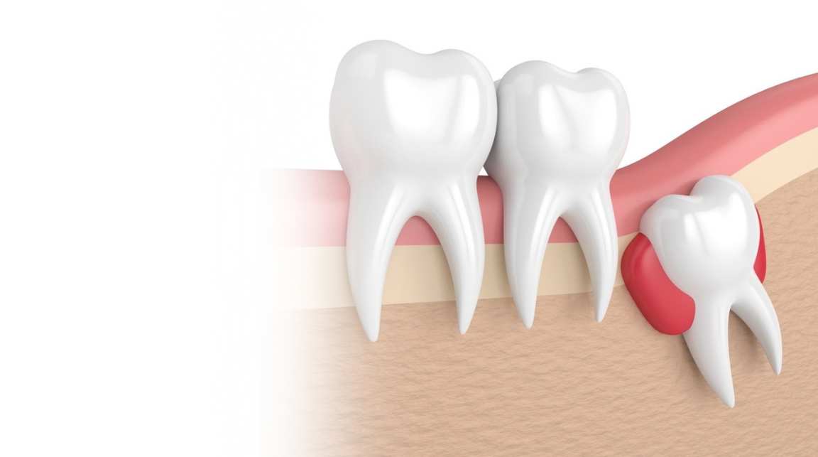 Wisdom Tooth Removal in Mysore at Umbrella Aesthetics